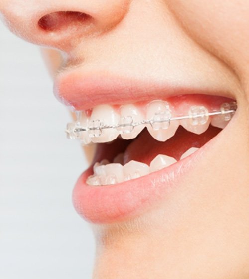 Cost Of Braces Richardson Improved Smiles Richardson Orthodontics