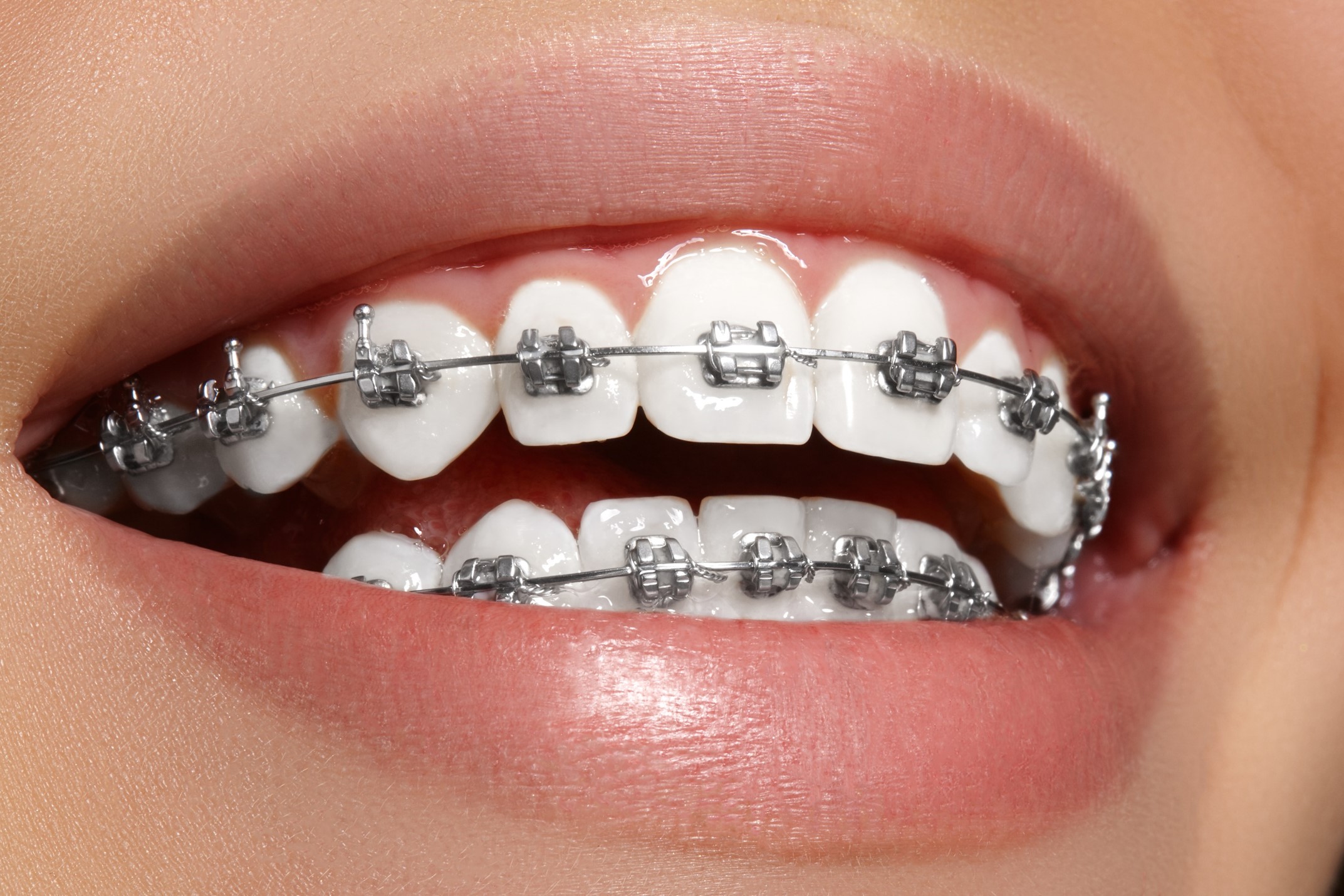 5 Reasons to Consider Traditional Braces l Richardson Orthodontics