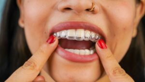 Woman placing Invisalign aligner on her top teeth